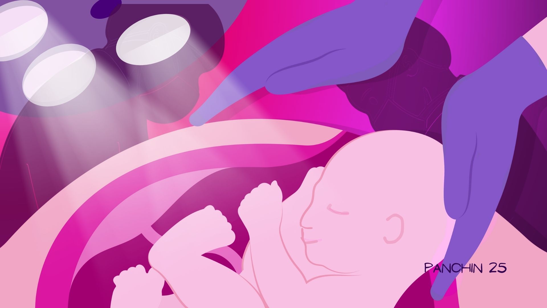 Parto por Cesarea Parto por cesárea