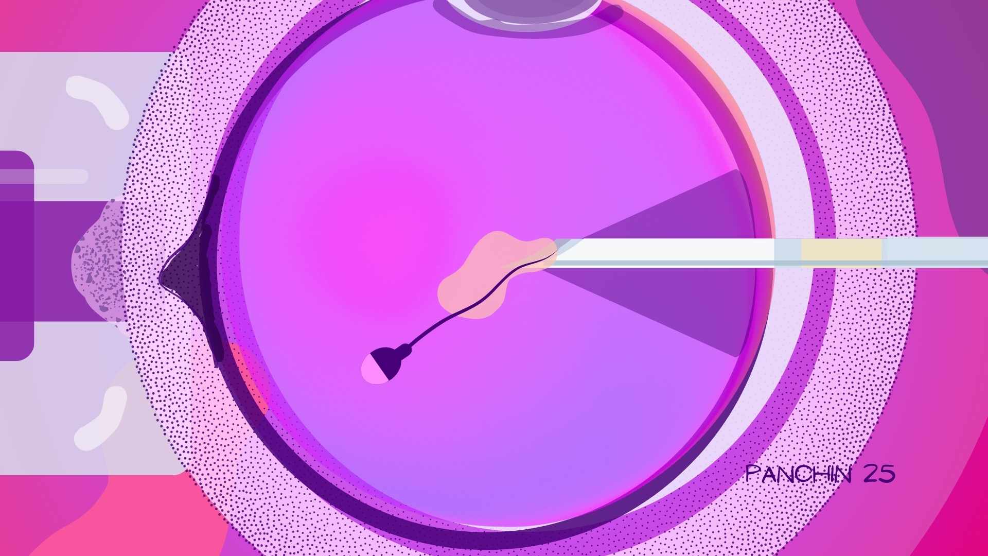 ICSI qué es, cuándo se recomienda y cómo se realiza paso a paso ICSI qué es, cuándo se recomienda y cómo se realiza paso a paso