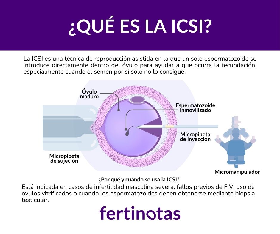 Que es la icsi ICSI microinyección de espermatozoide