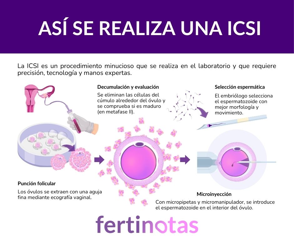 icsi asi se hace paso a paso Cómo se hace la ICSI paso a paso