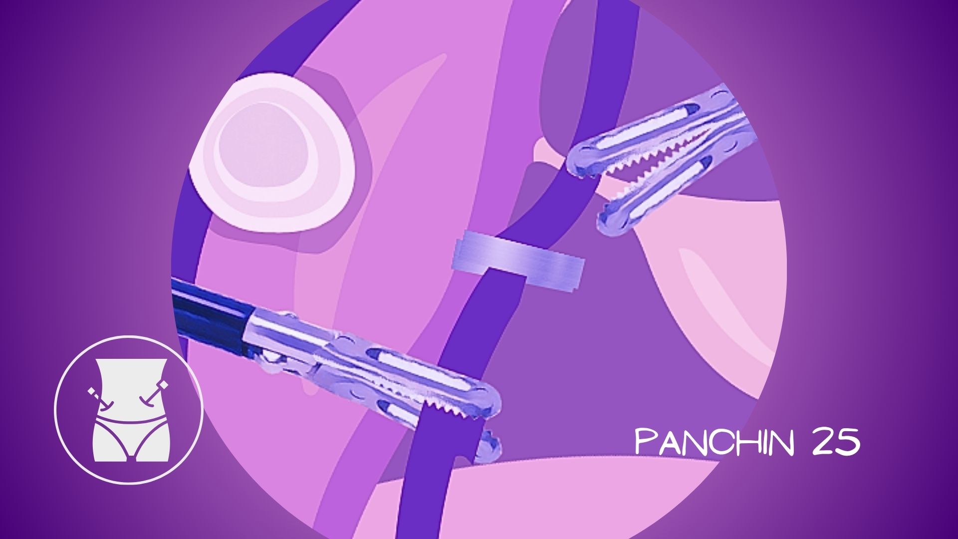 Ilustración médica de una miomectomía laparoscópica con instrumental quirúrgico accediendo al útero para extirpar miomas uterinos.