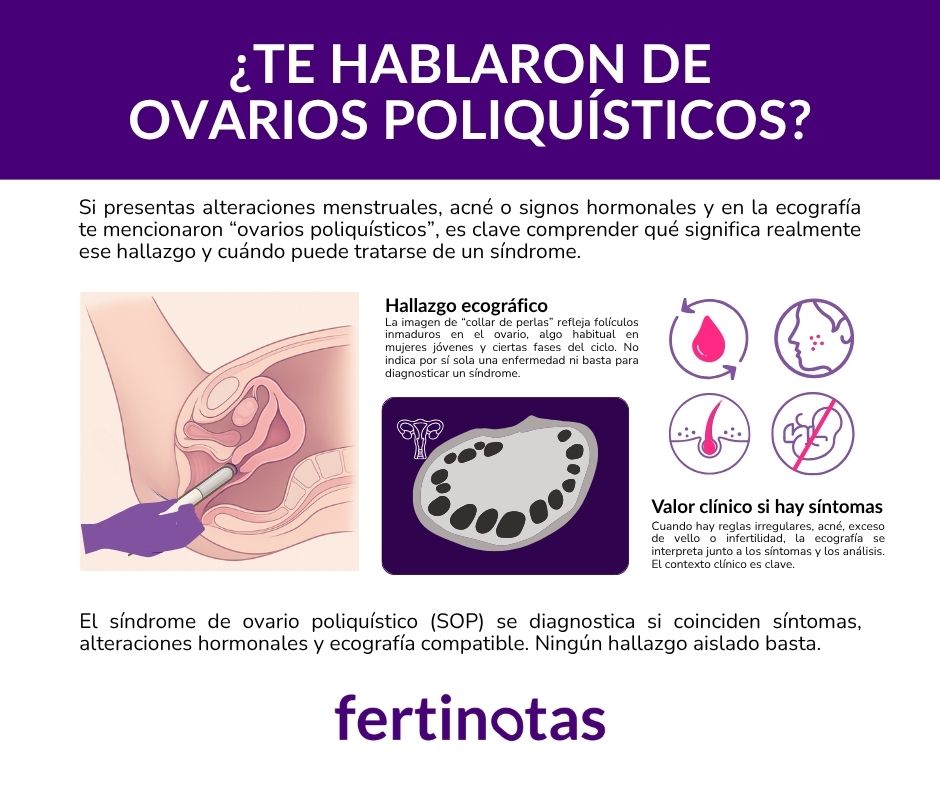 Ilustración que explica la diferencia entre ovarios con folículos ecográficos y el diagnóstico del síndrome de ovario poliquístico (SOP).