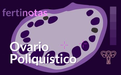 Síndrome de ovario poliquístico: síntomas, diagnóstico y tratamiento