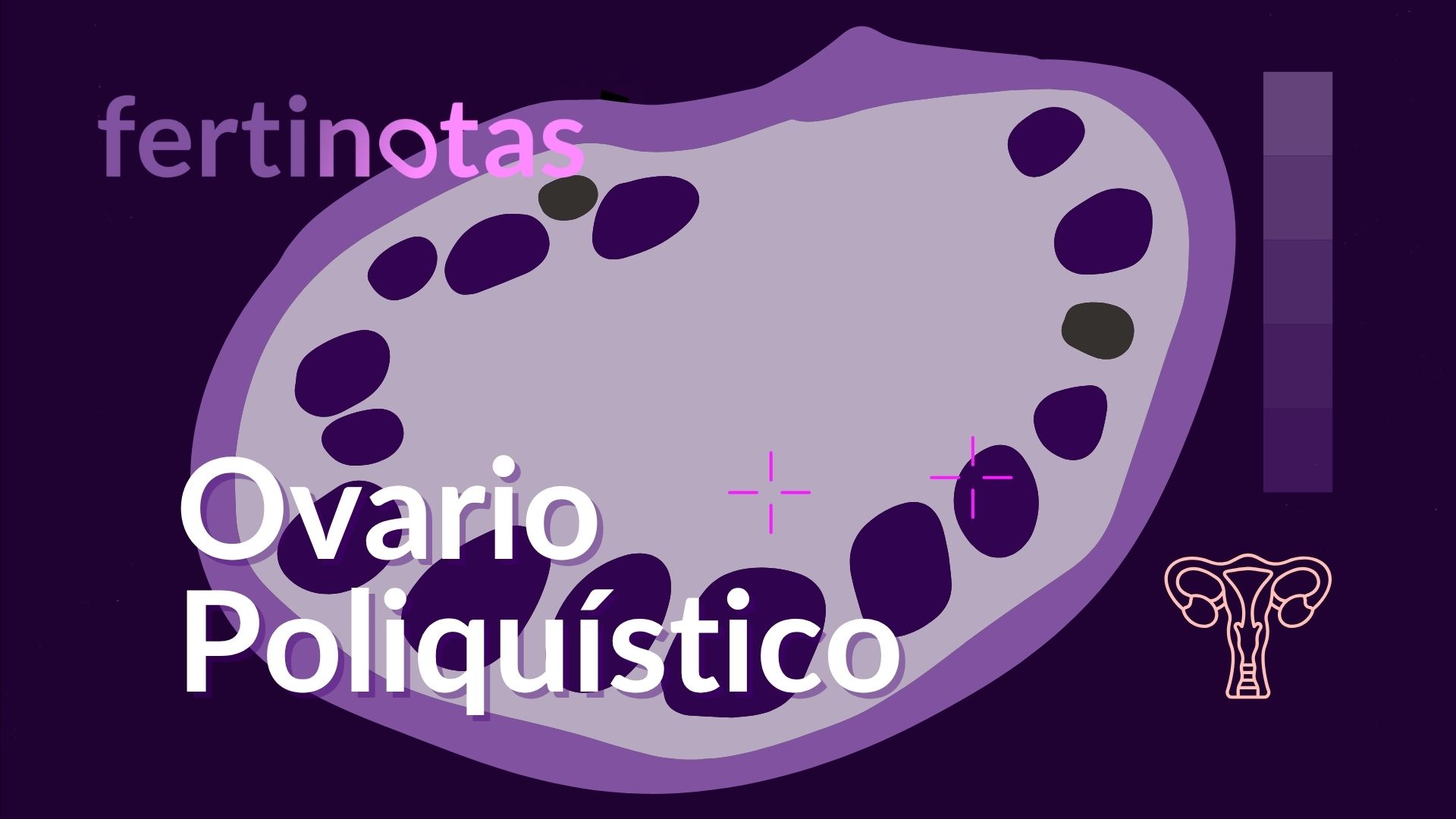 Ilustración médica sobre imagen ecográfica que muestra un ovario con múltiples folículos pequeños en disposición periférica, típica del síndrome de ovario poliquístico.
