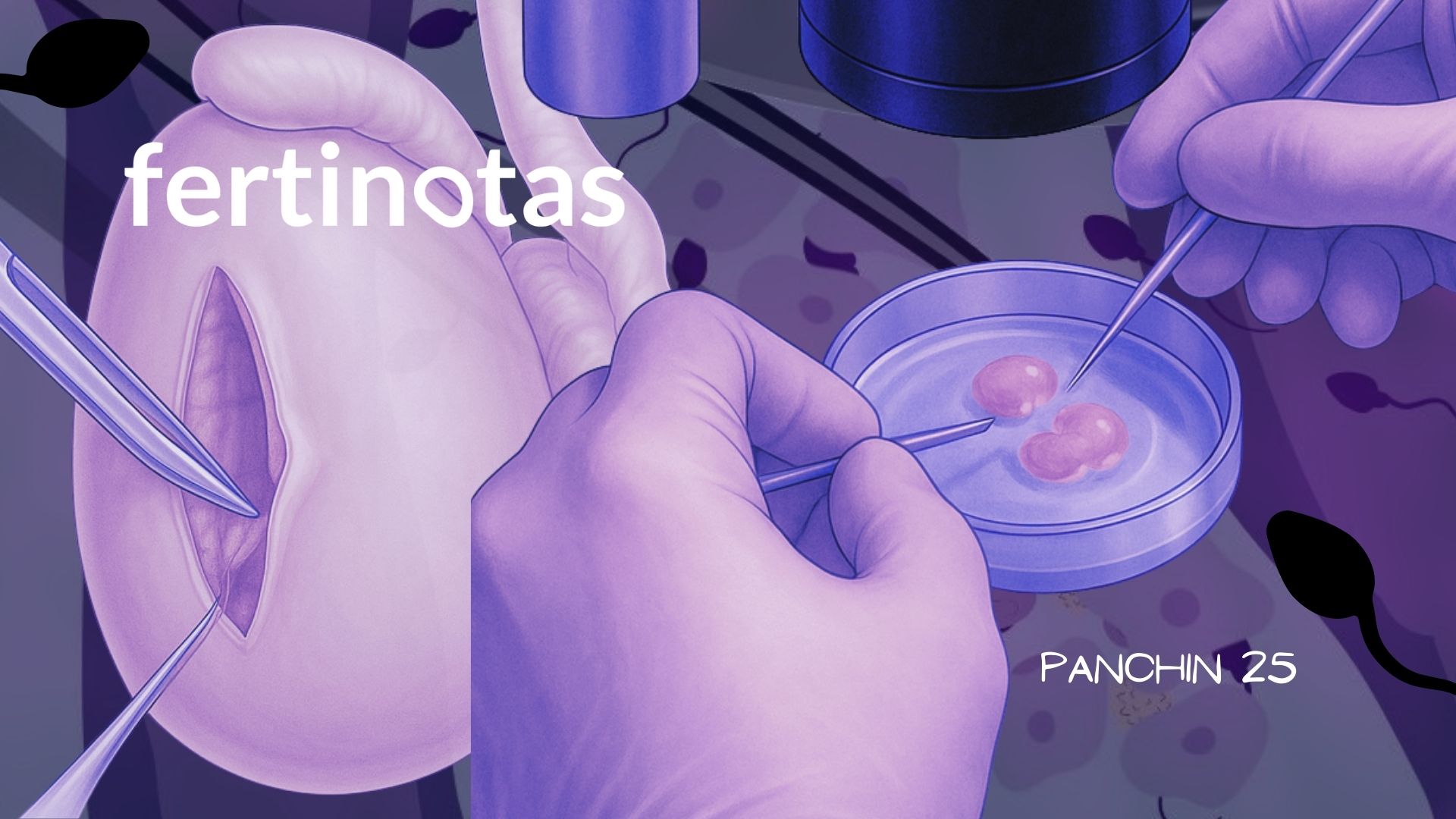 Qué es la TESE o biopsia de testiculo para estraer espermatozoides Ilustración médica de la TESE o biopsia testicular, mostrando la extracción de espermatozoides del testículo y su análisis al microscopio por un embriólogo