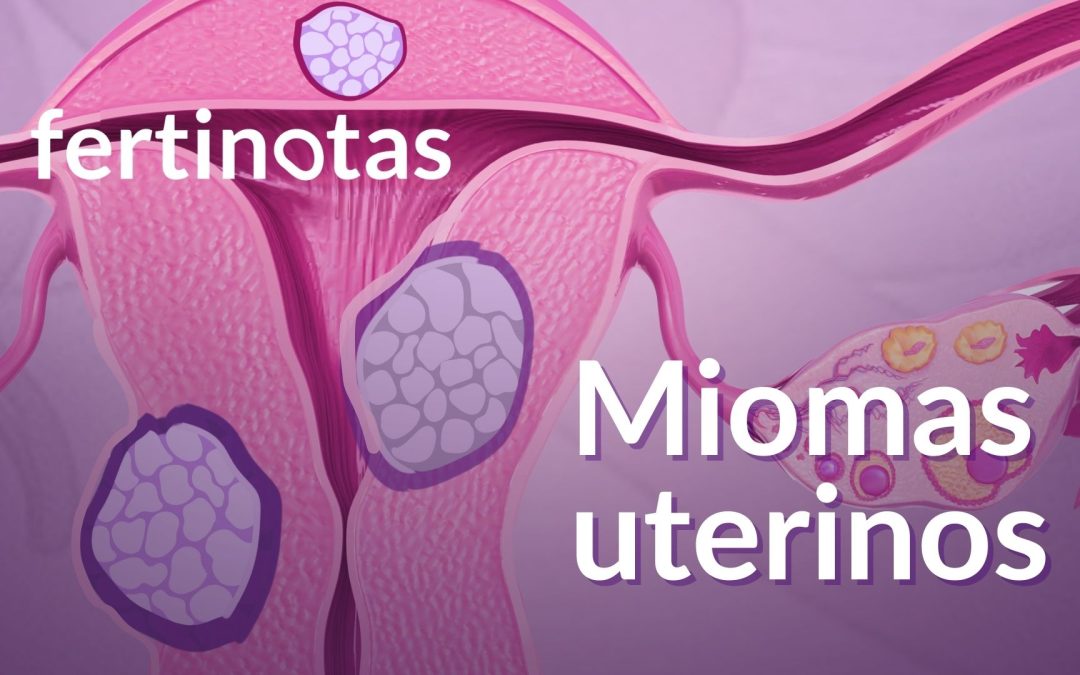 Miomas uterinos y fertilidad: qué son, síntomas y cuándo tratarlos