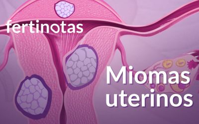 Miomas uterinos y fertilidad: qué son, síntomas y cuándo tratarlos
