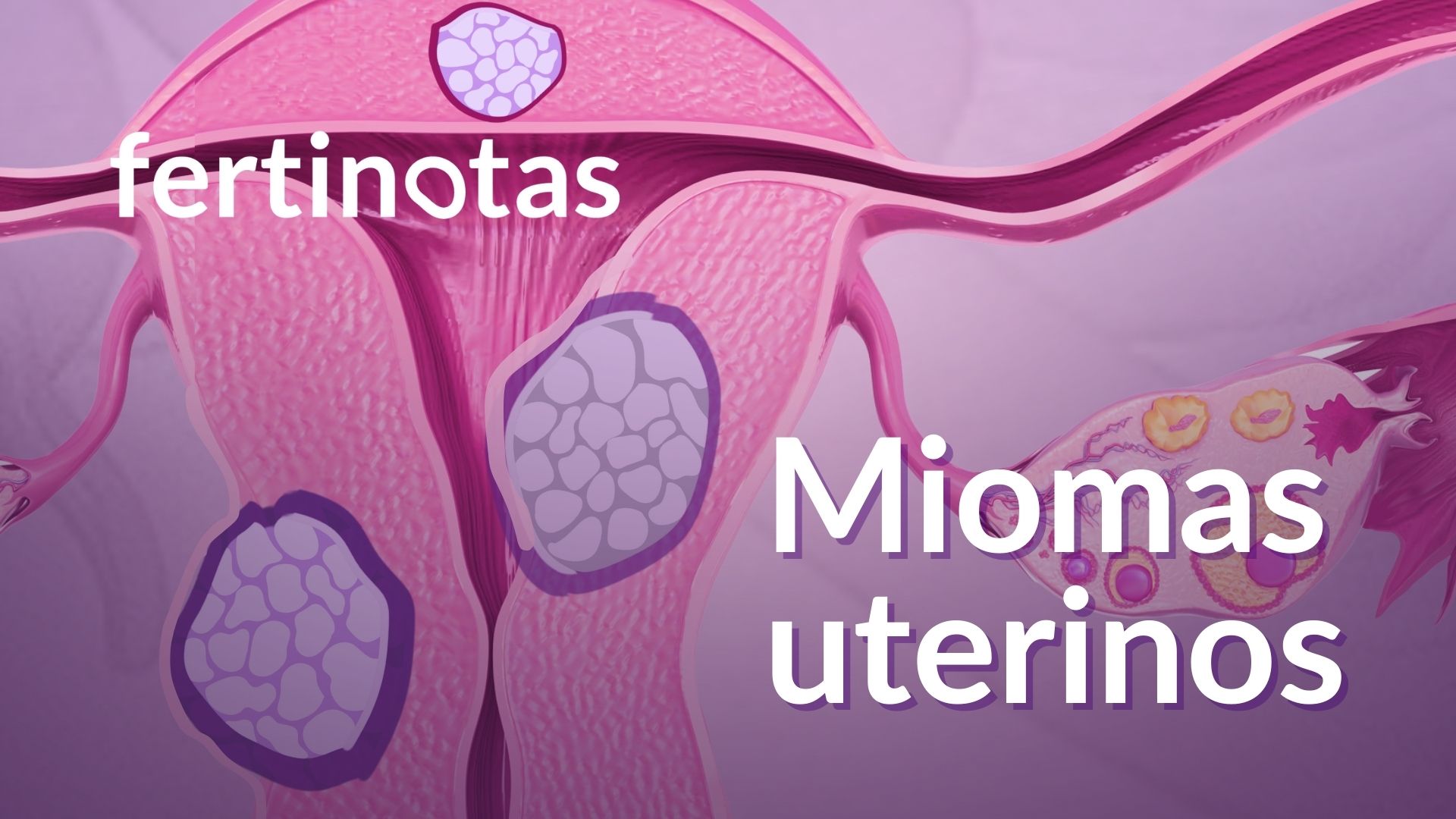 Representación visual del útero con distintos tipos de miomas: submucosos, intramurales y subserosos