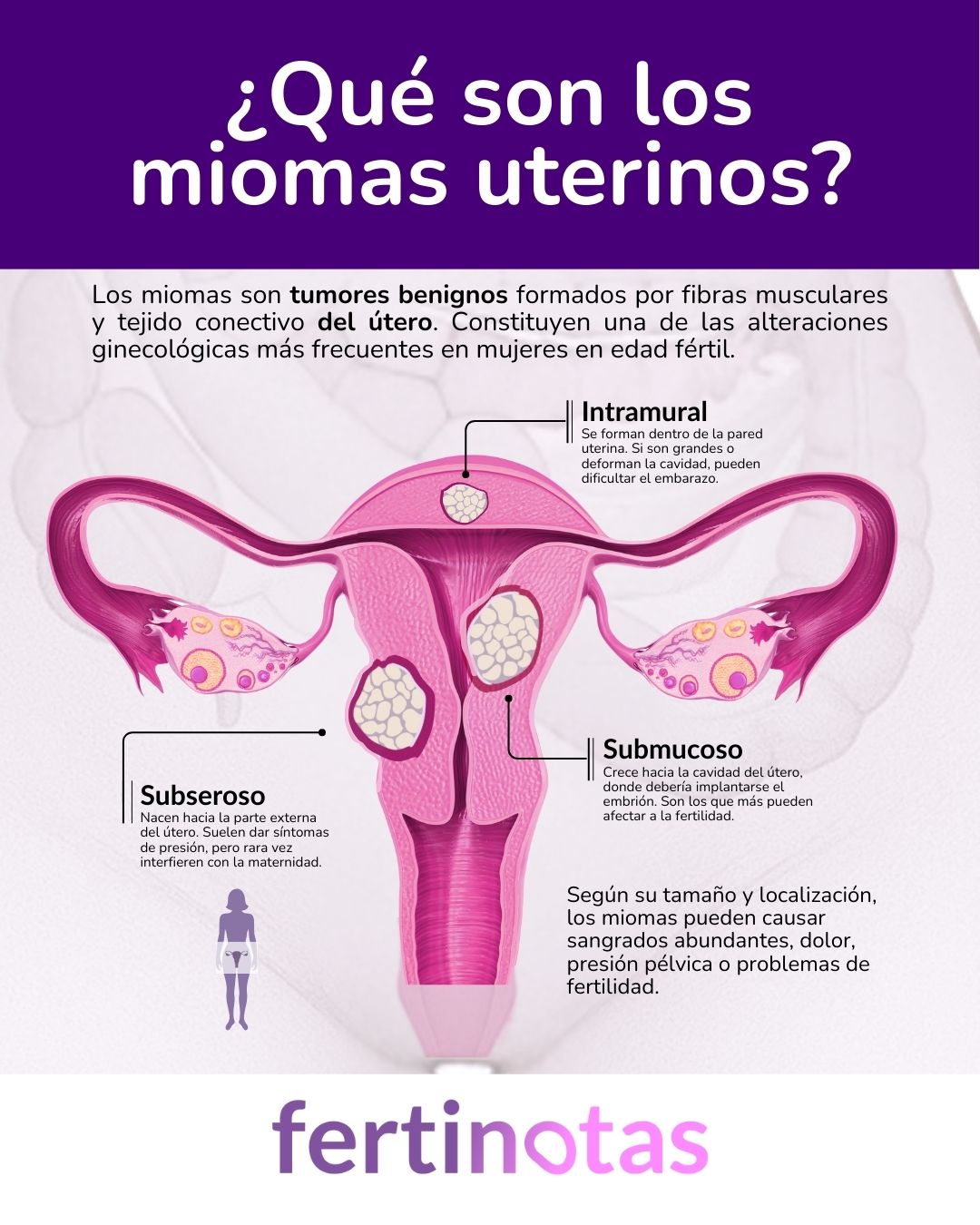Infografía médica que explica qué son los miomas uterinos, su localización y consecuencias clínicas