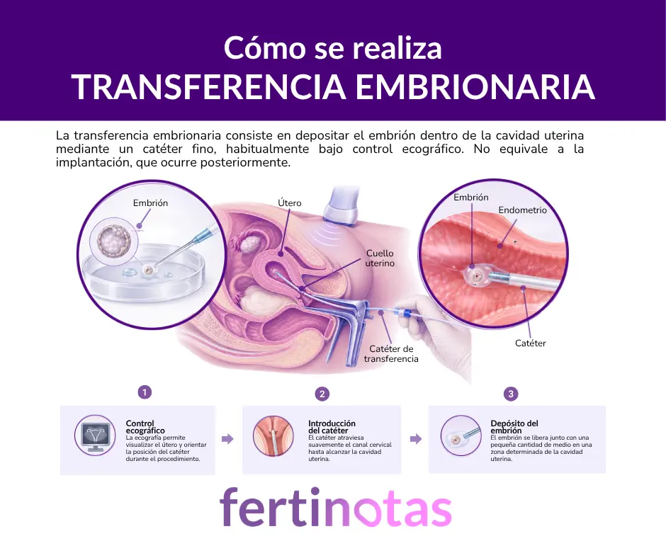 como se realiza la transferencia de embriones fiv Infografía sobre cómo se realiza la transferencia embrionaria en FIV mediante un catéter fino y control ecográfico, desde la preparación del embrión hasta su depósito en la cavidad uterina.